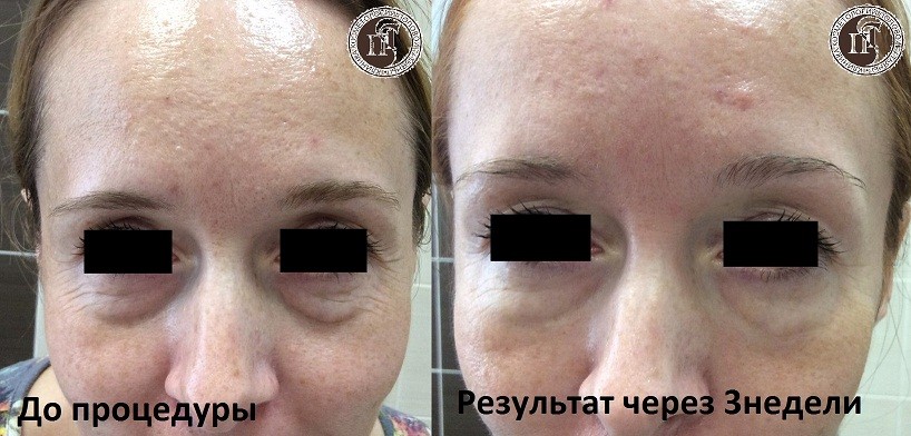 РАБОТА С НОСОСЛЕЗНОЙ БОРОЗДОЙ ПРЕПАРАТОМ REDENSITY II EYES