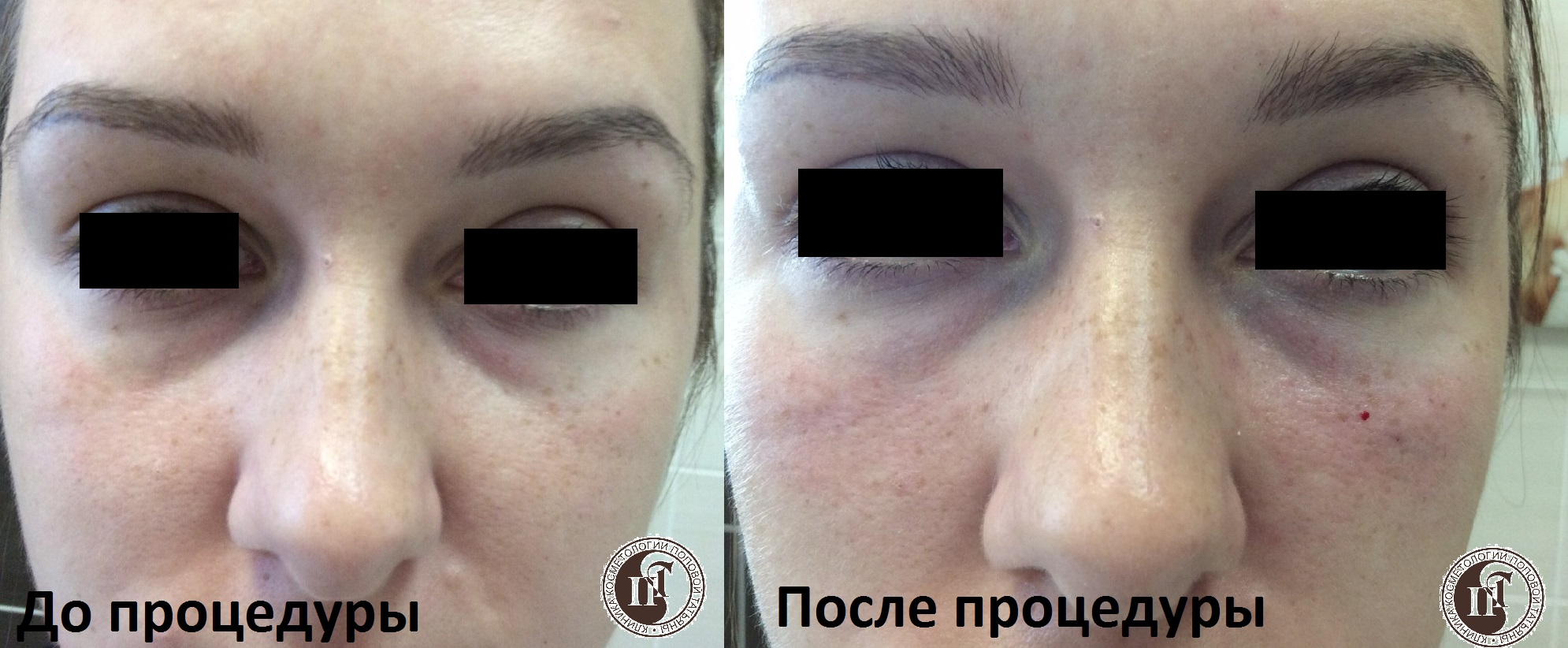 Работа с носослезной бороздой гелем на основе гиалрулоновой кислоты - фото 4